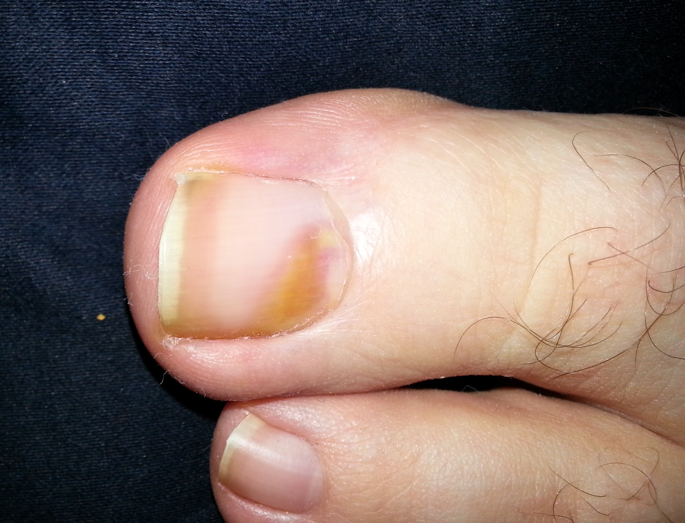 Why Is There Something Black Under My Toenail